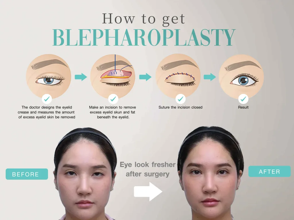Operative Preparation for Blepharoplasty to Correct Ptosis: