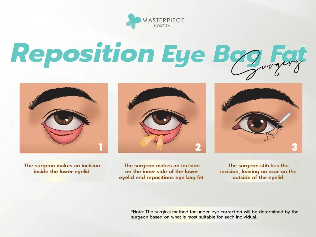 eye bag fat repositioning surgery