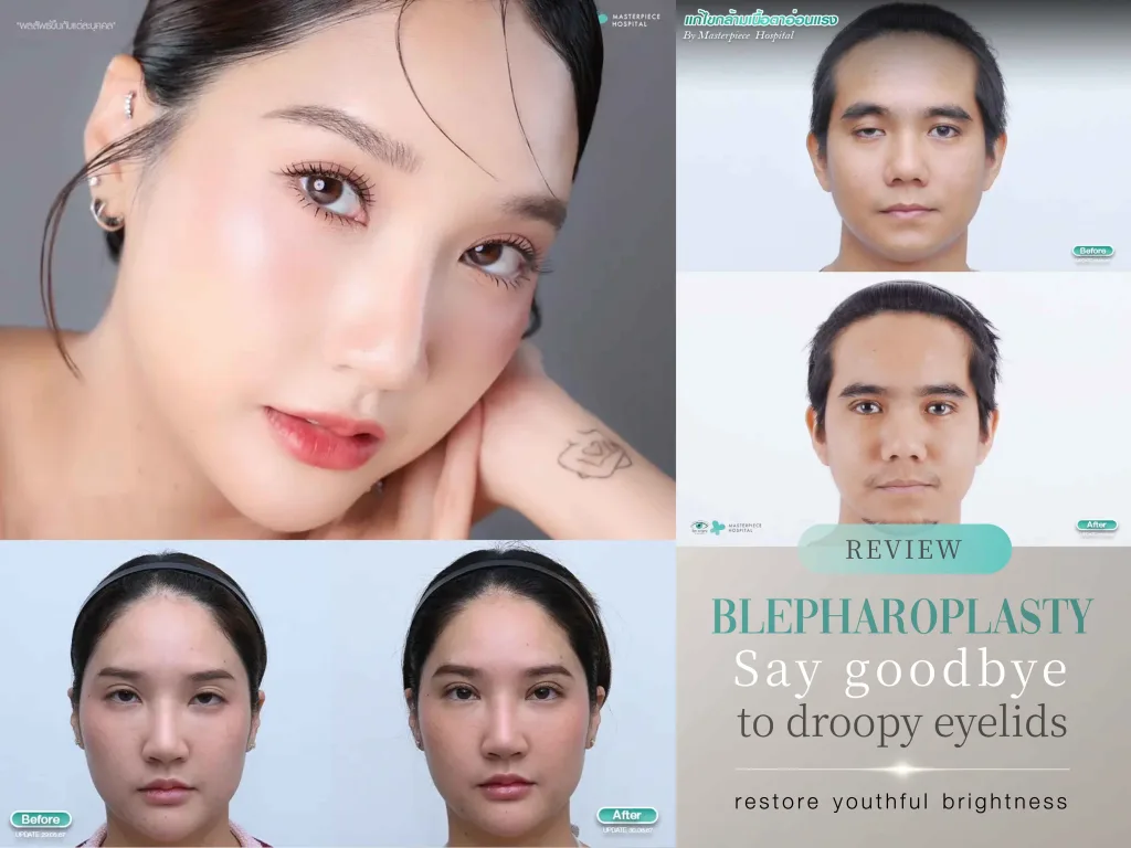 No Pain During Blepharoplasty!