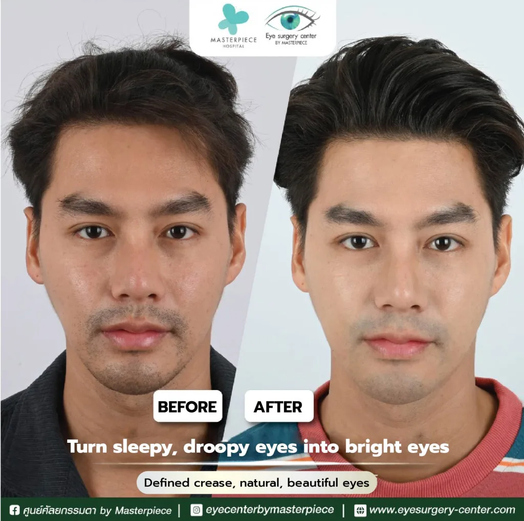 befor and affter review Reposition eyebag fat