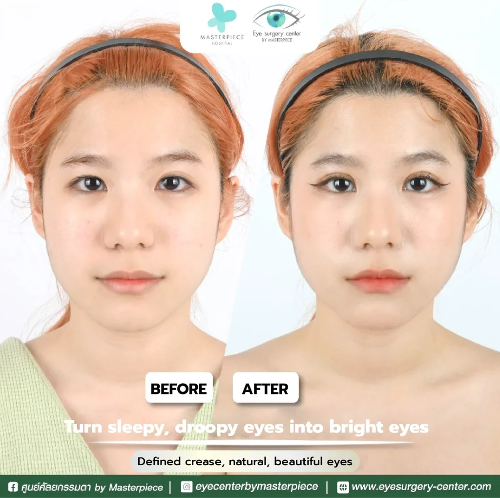 befor and affter review Reposition eyebag fat