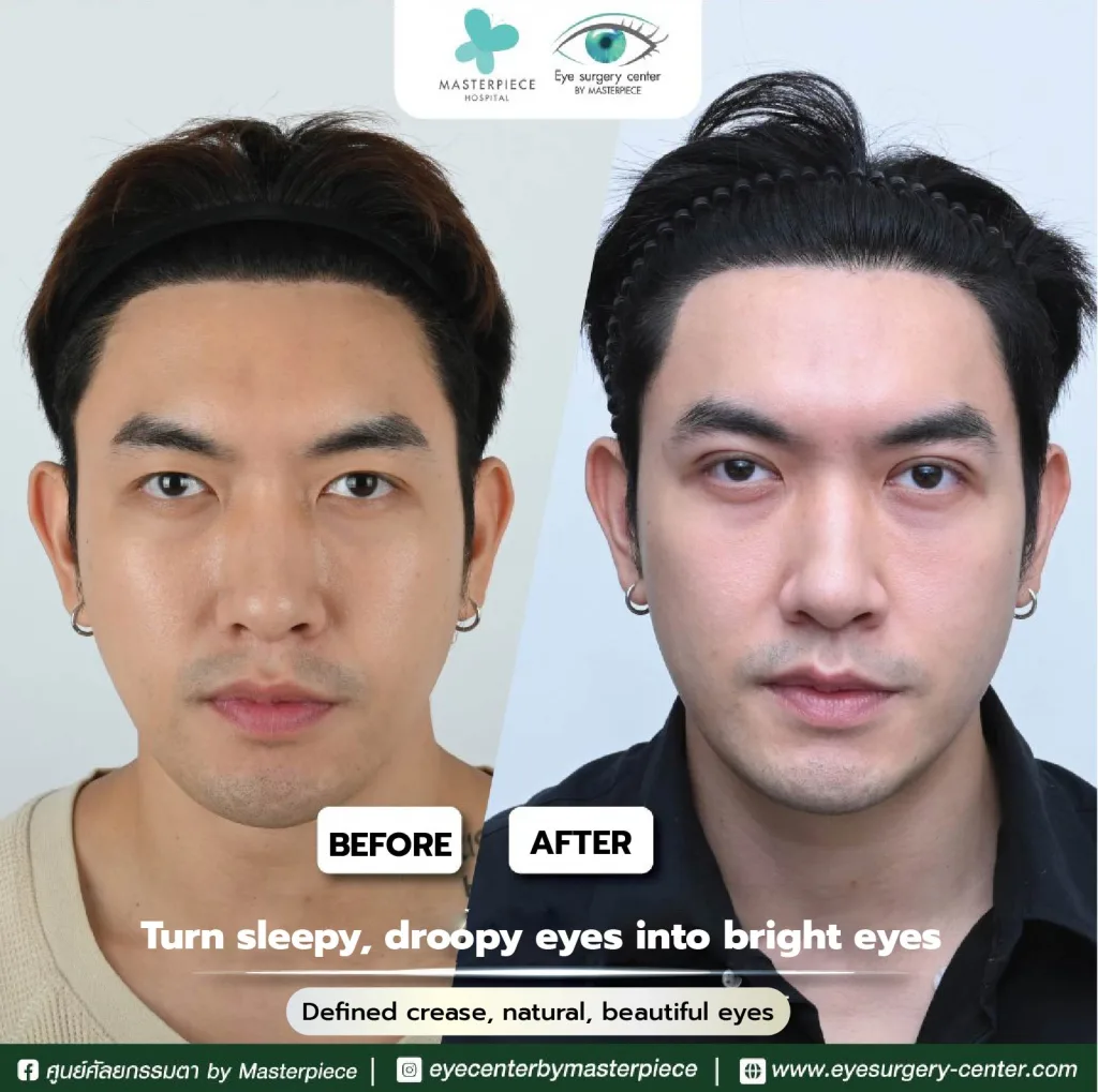 befor and affter review Reposition eyebag fat