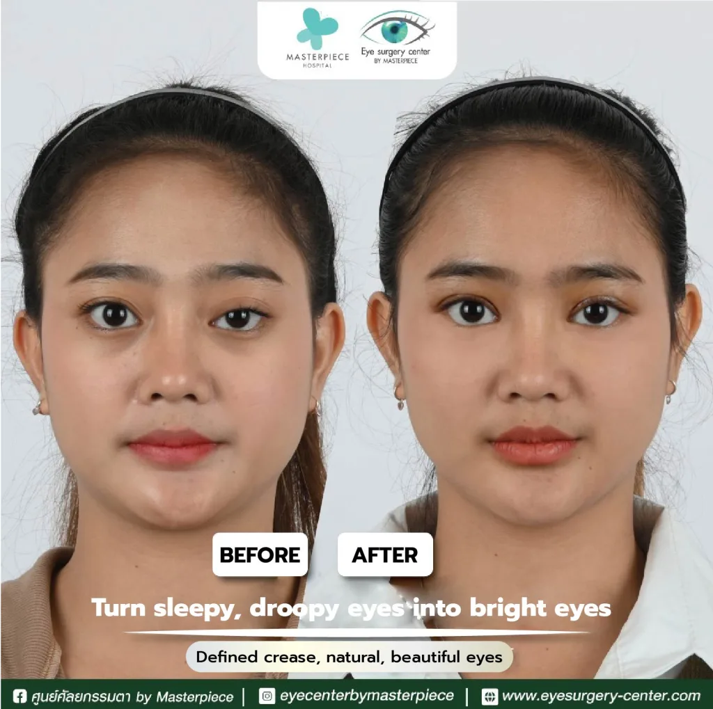 befor and affter review Reposition eyebag fat