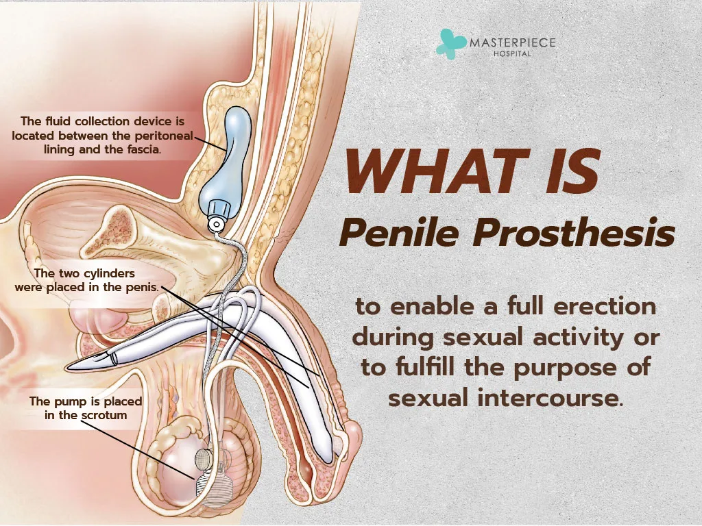 What is Penile Prosthesis