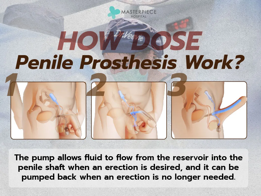 How does a Penile Prosthesis work?