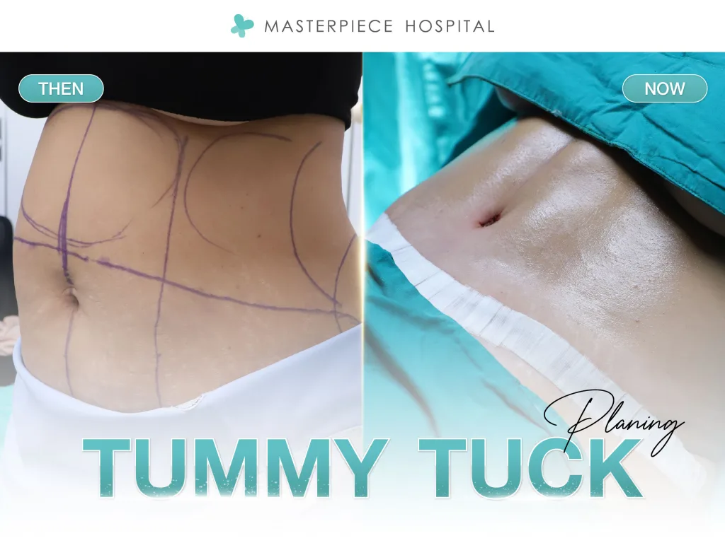 Full Abdominoplasty