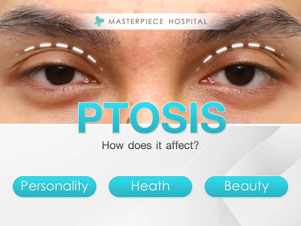 How does Ptosis affect you?