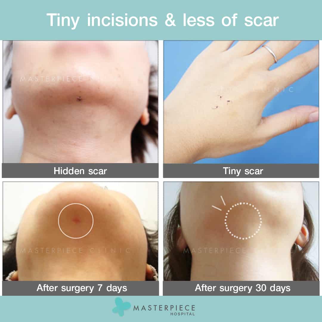 Tiny incisions & less of scar
