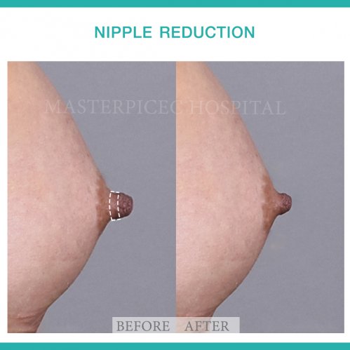Nipple Reduction Before After