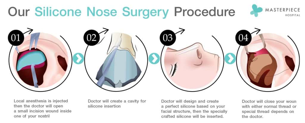 Nose Surgery Procedure