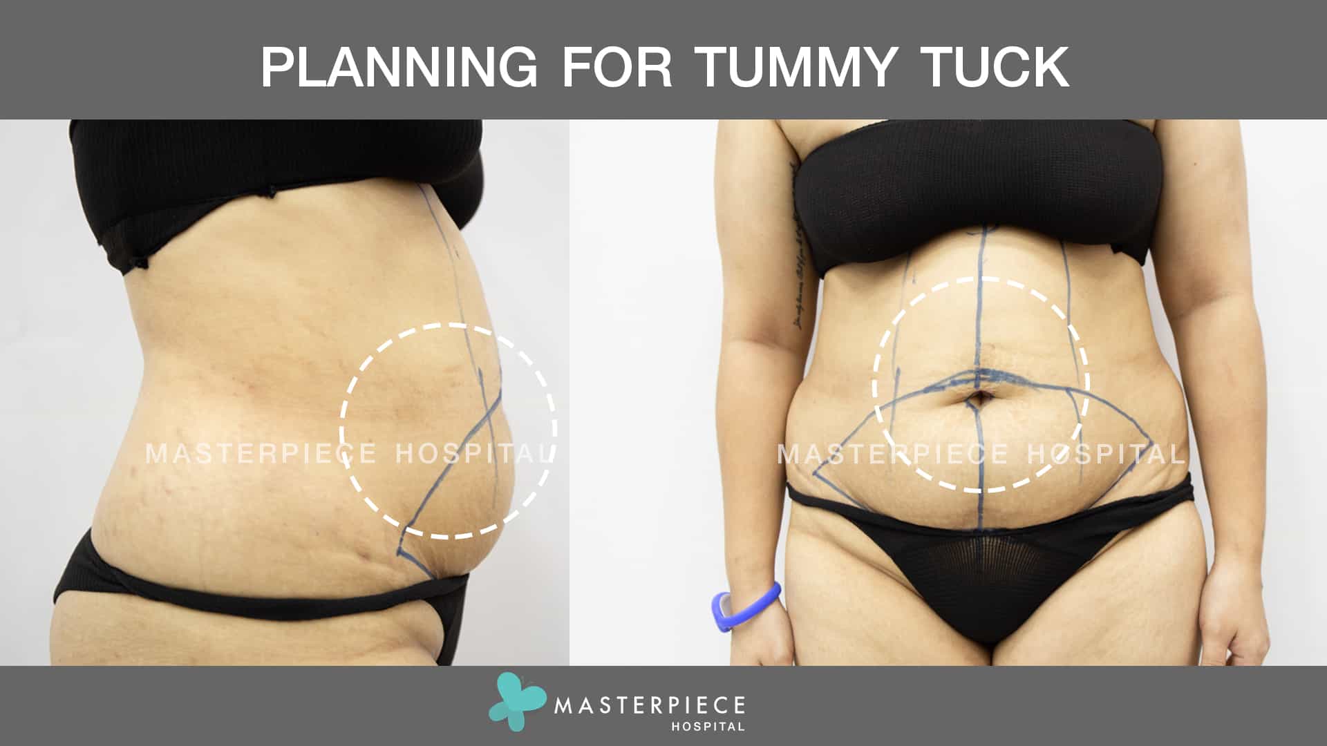 Planning for Tummy Tuck