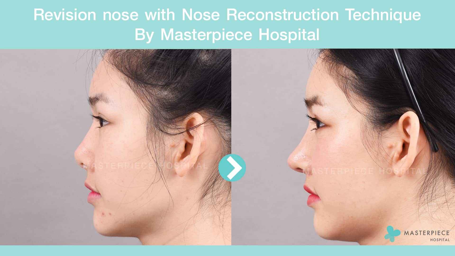 Revision nose with Nose Reconstruction Technique 02