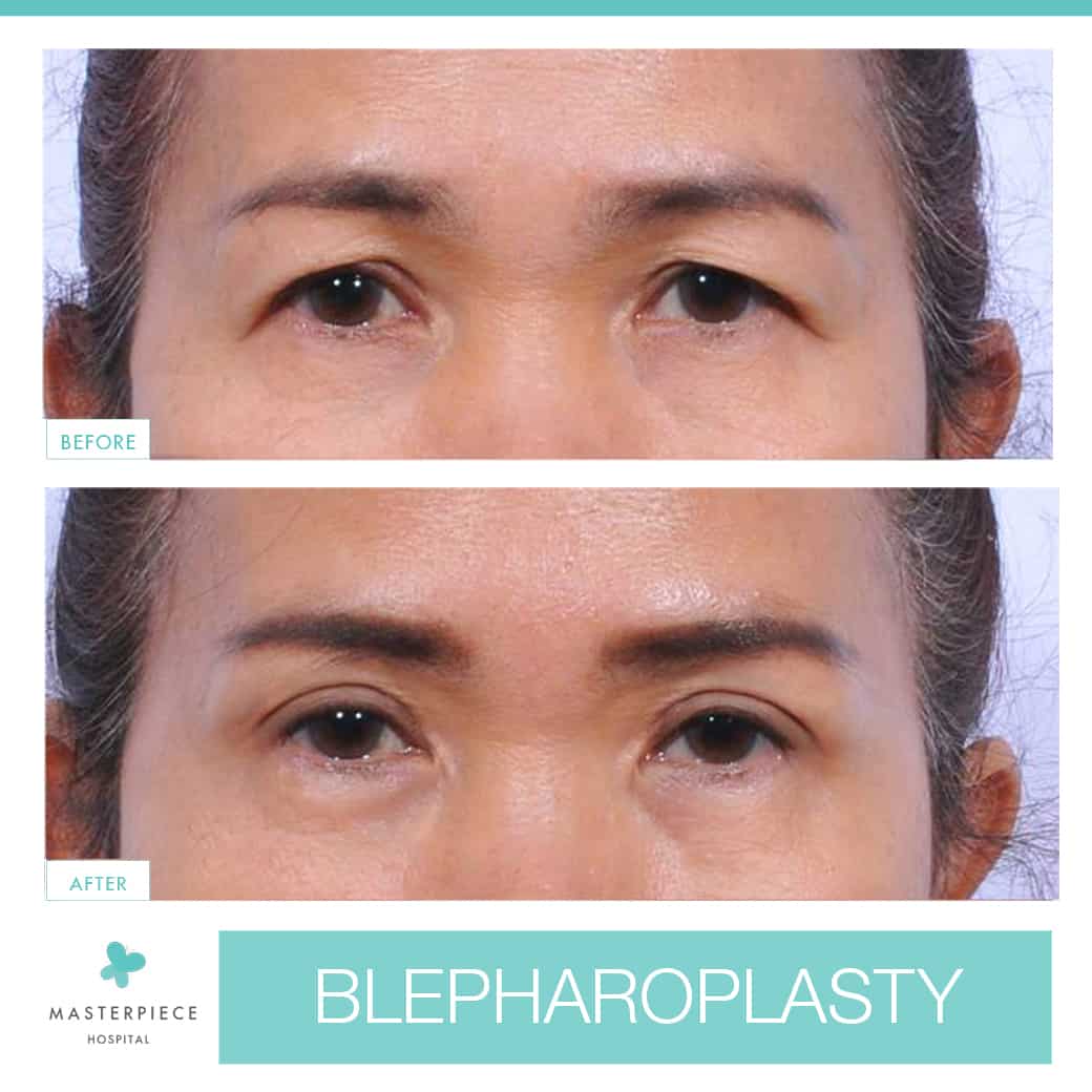 before and after Blepharoplasty