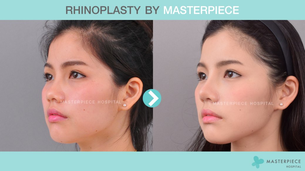 Before After Rhinoplasty