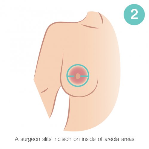 inside of areola areas