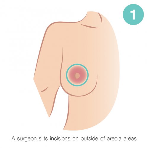 outside of areola areas