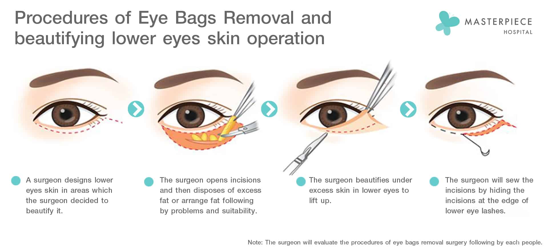 Procedures of Eye Bags Removal and beautifying lower eyes skin operation