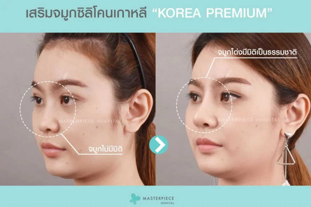Korea premium nose surgery