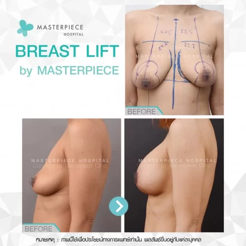 Breast lift by masterpiece