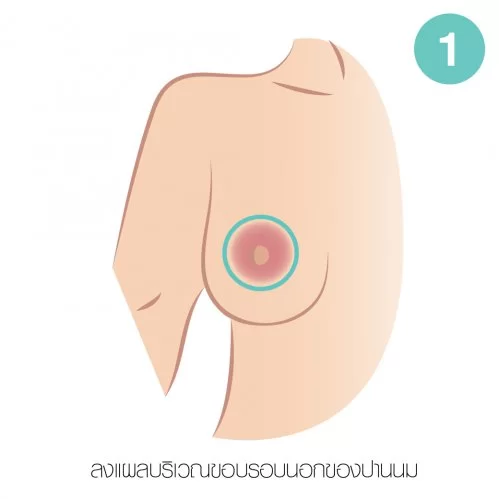 在乳晕周围切口