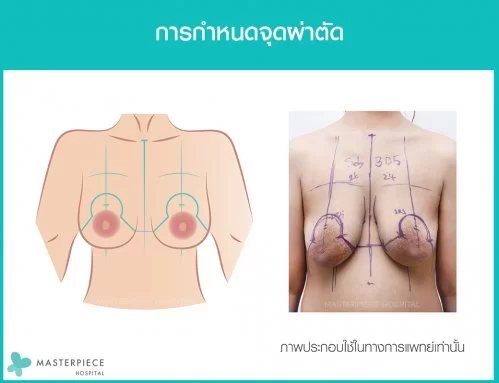 Mark point before surgery