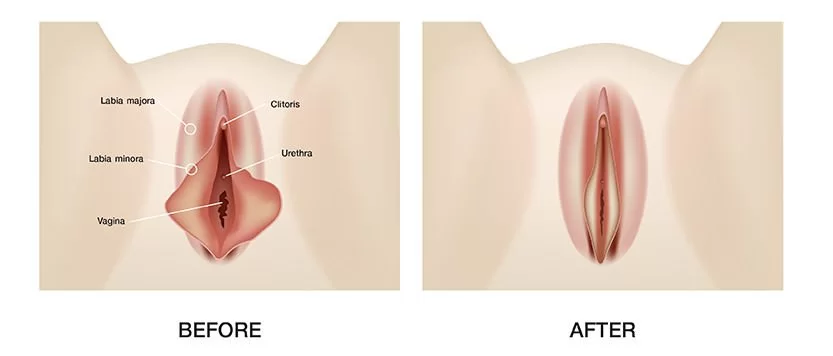 阴唇整形术或阴唇整形手术前的图片和电影对比