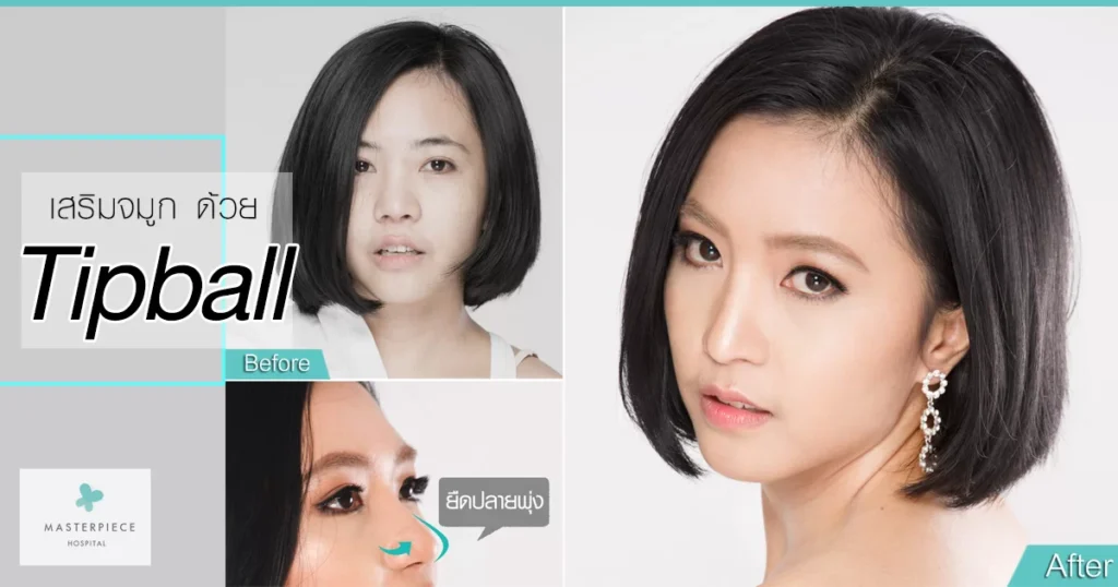 使用特殊的拉伸尖端进行隆鼻 before-after