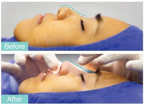 4 Tip ball before-after