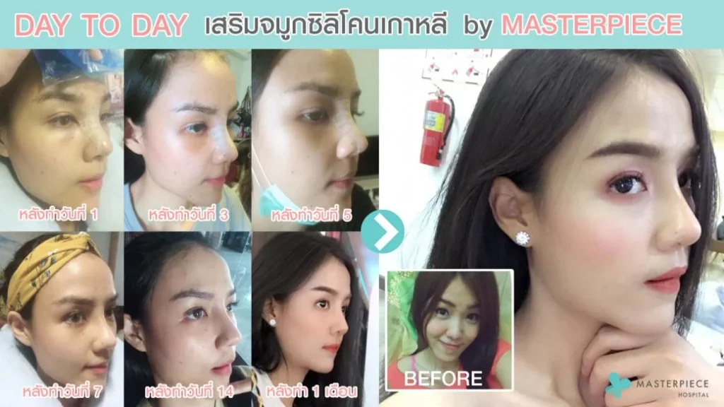 鼻子手术后,一天一天