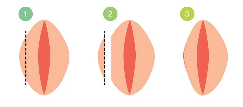 为什么要在 “马斯特皮医院” 进行外阴唇整形手术?