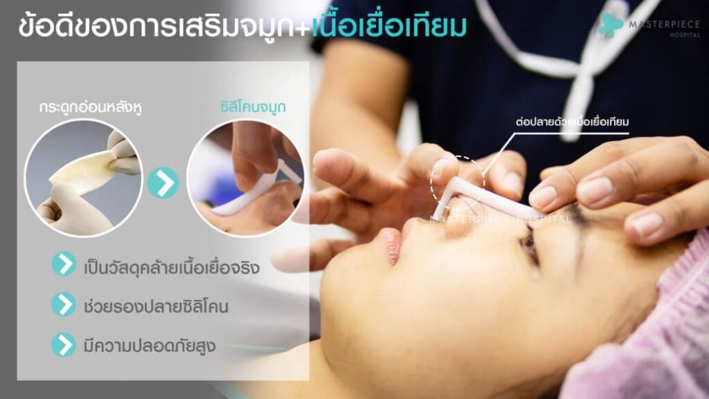 人工组织隆鼻的优点