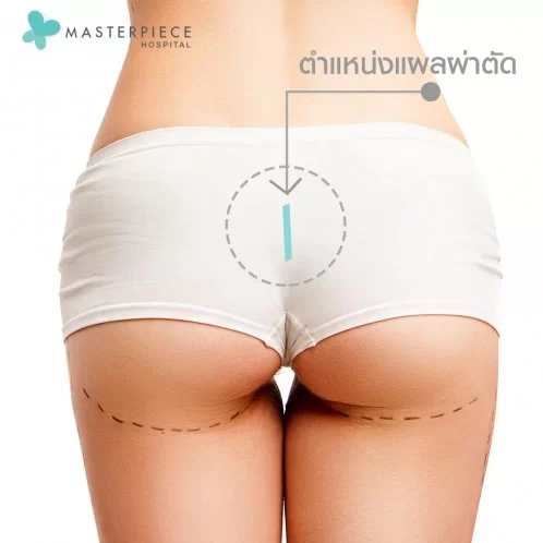 对于臀部增大手术,臀部凹陷矫正