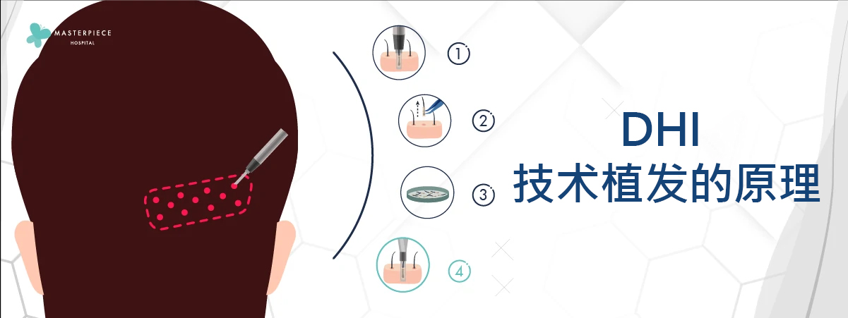 DHI技术种植头发原理