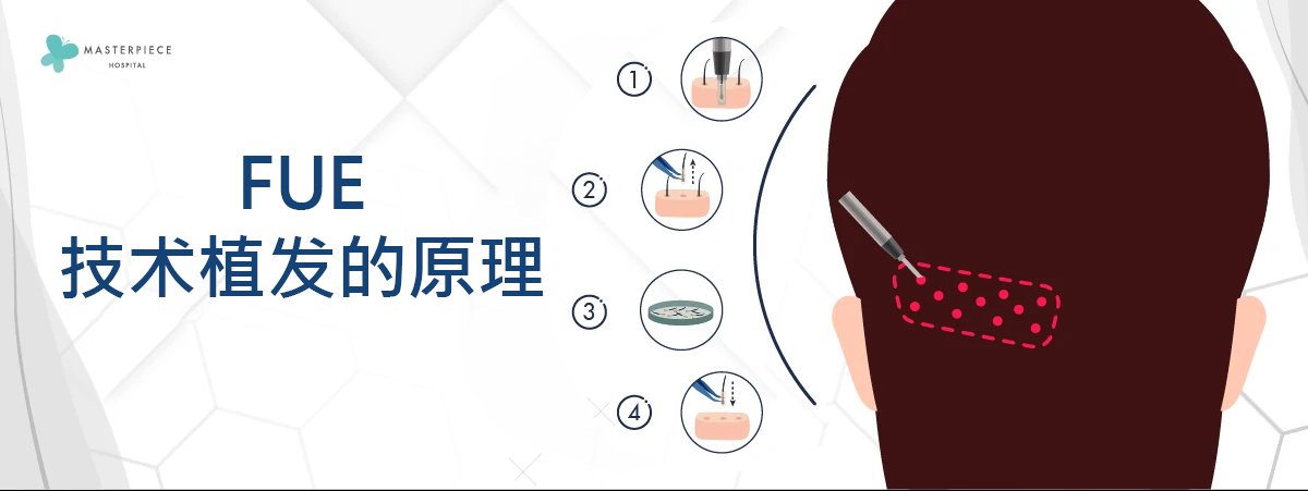 FUE技术种植头发原理