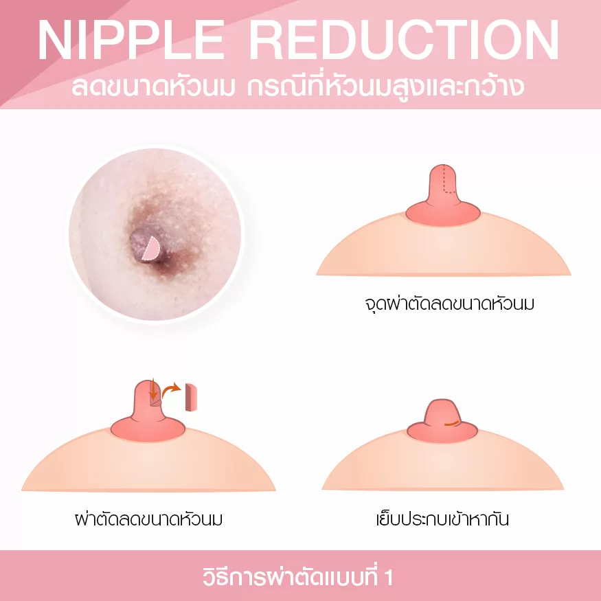 乳头高且宽的问题