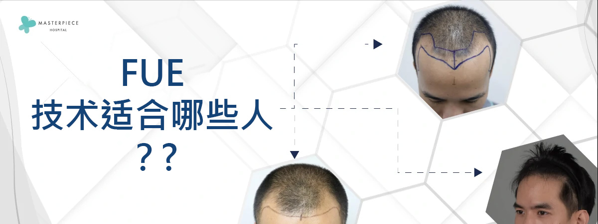 FUE技术适合哪些人？