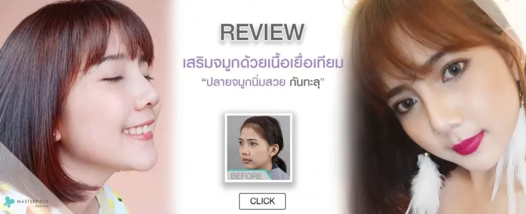 人工组织隆鼻综述