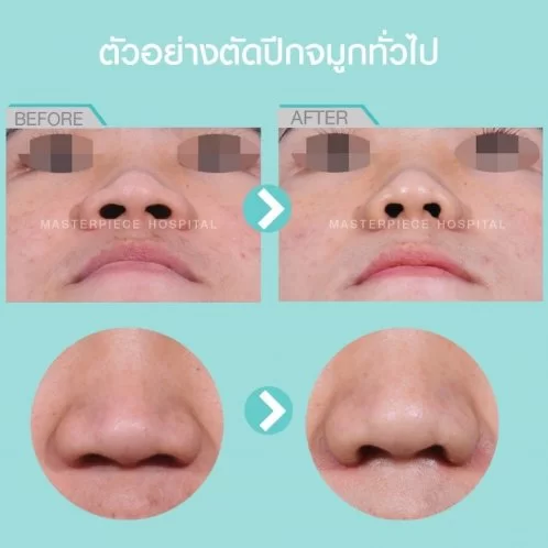 鼻部手术的优点