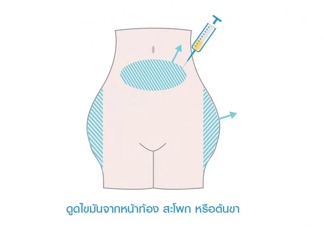 如何利用自己的脂肪细胞进行隆胸手术步骤1: