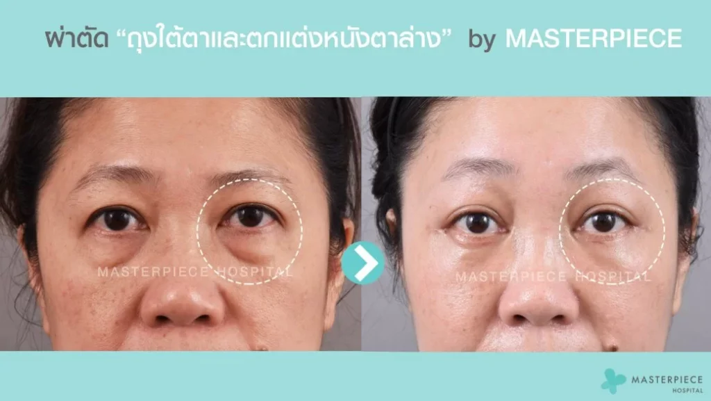 眼袋和下眼睑手术前后的照片,可以使脸部看起来更年轻。