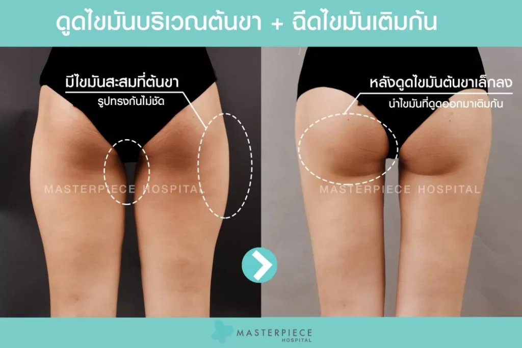 填充臀部脂肪 before-after