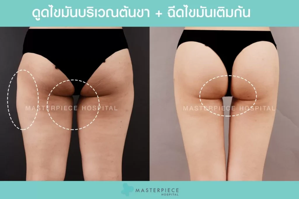 填充臀部脂肪 before-after