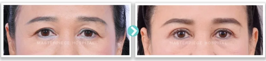 手术前后进行复查以矫正上睑下垂。