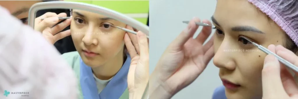 小切口双眼皮术 (SMALL INCISION DOUBLE EYES)