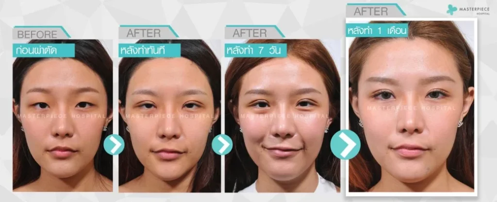 只需 1 个月回顾一下双眼皮手术前后，您就会拥有美丽、自然的外观。