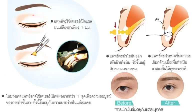 除了双眼皮之外,构成漂亮眼睛的要素还有哪些?