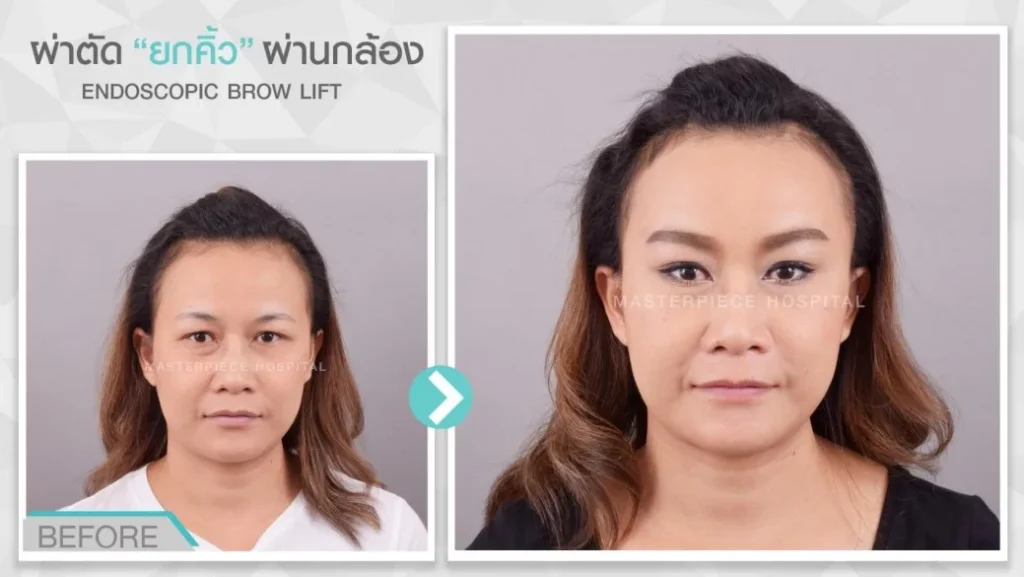 腹腔镜提眉手术前后的回顾。