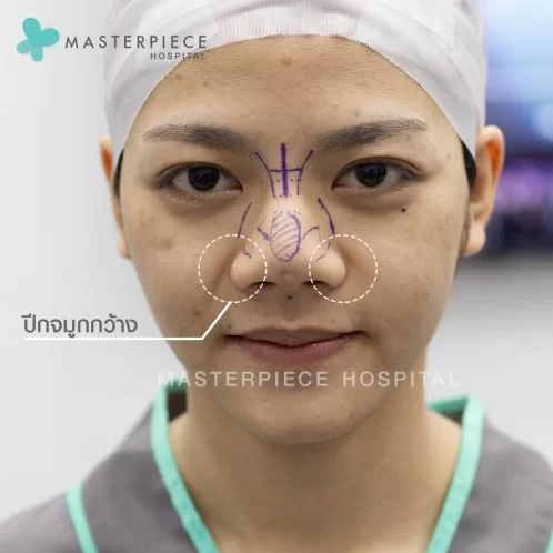 只割鼻翼不隆鼻能美吗?