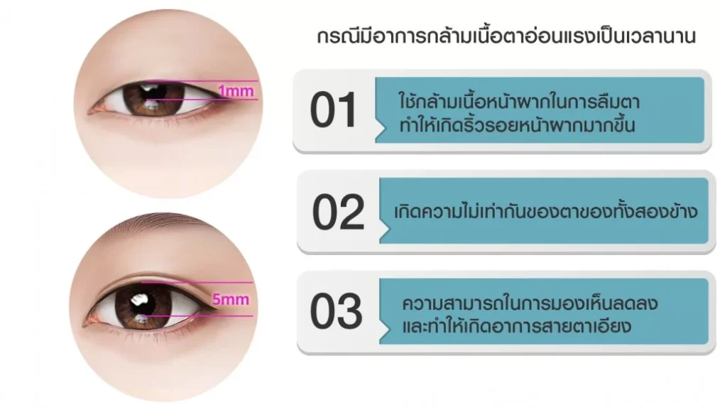 你有眼部肌肉疲弱（睡眠性眼皮下垂）的症状吗？