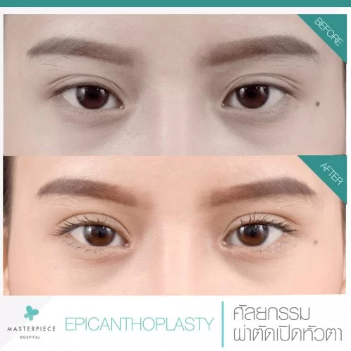 ศัลยกรรมผ่าตัดเปิดหัวตา ช่วยทำให้ตาดูมีความกลมโต